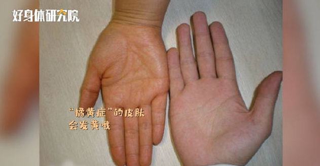 宝宝黄疸高妈妈能吃胡萝卜吗(宝宝有黄疸妈妈可以吃胡萝卜吗?)