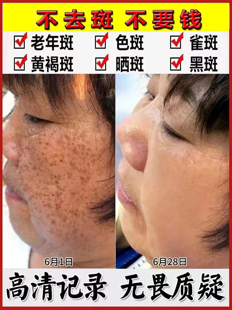老年斑的种类(老年斑的形成原因)