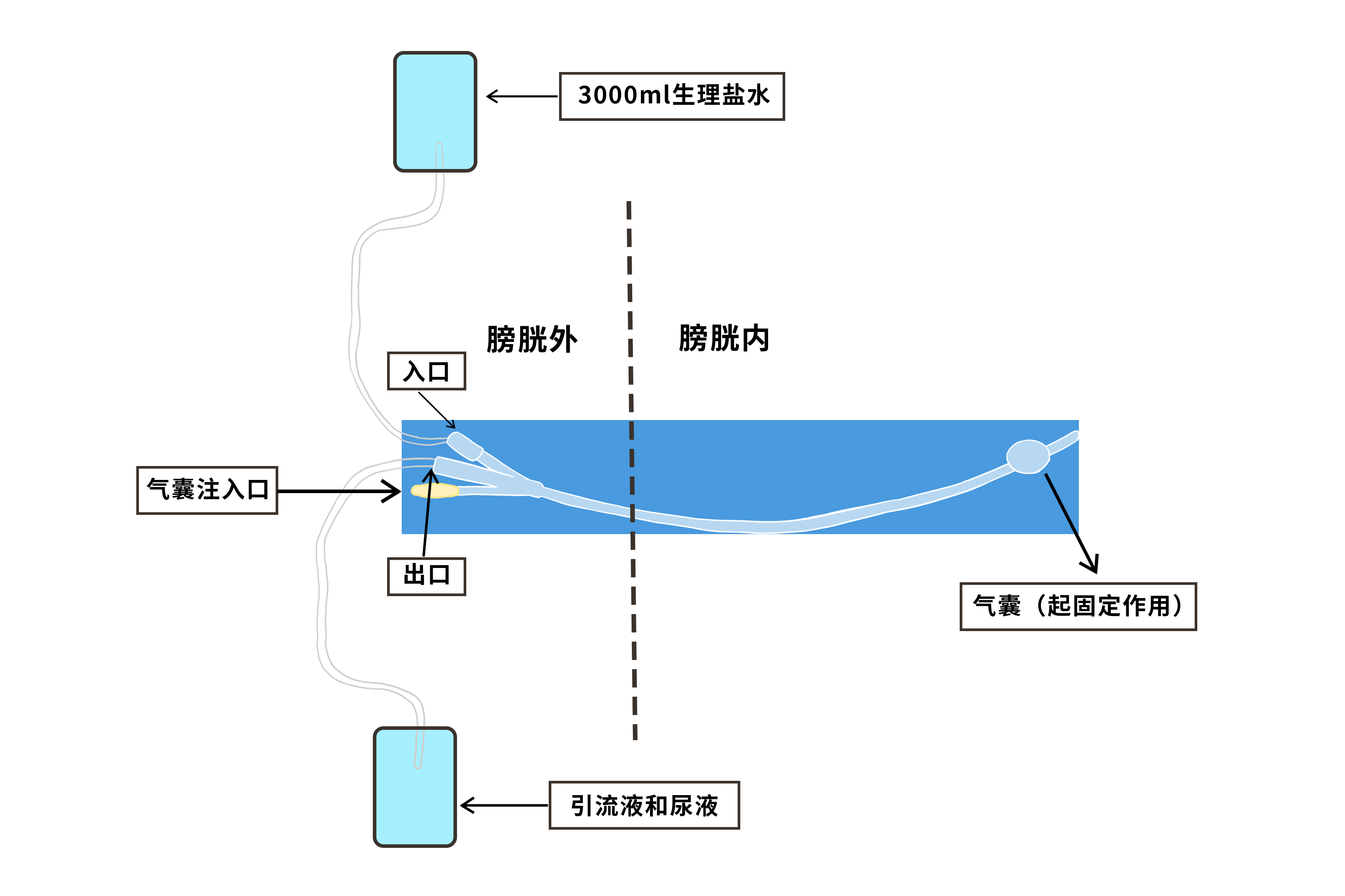 膀胱冲洗新技术(膀胱冲洗新技术申报书)