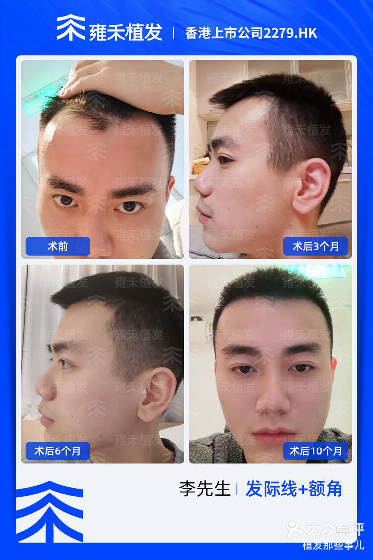 发际线需要种植(发际线种植一般需要多少钱呢)